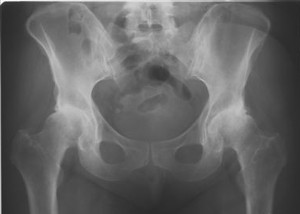 XRay image of severe osteoarthritis of both hips before Surgery of Primary Total Hip Replacement.
