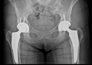 XRay image of both hips after Surgery for Primary Total Hip Replacement