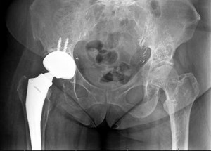 XRay image of hip with hip replacement implant in position.