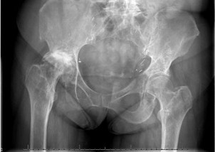 XRay image of hip before surgery showing right hip arthritis with erosion of the acetabulum (hip socket)) and pelvic tilt.