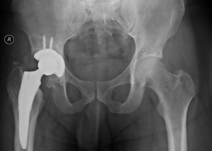 XRay of hip after surgery showing hip replacement implant in position.