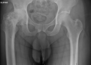 XRay of hip before hip replacement surgery.