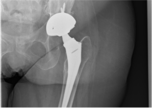 XRay image of hip after hip replacement surgery, showing implant in position.