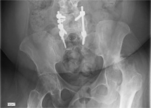 XRay image of hip before surgery, showing severe hip arthritis and dislocation of the hip.