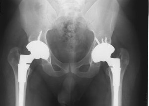 XRay image after surgery of bi-lateral hip replacement, with implants in position.