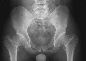 XRay image of hip before bi-lateral hip replacement surgery showing deformities and hip arthritis.