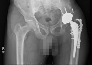 XRay image of left hip after surgery with previous fusion converted to a total hip replacement.