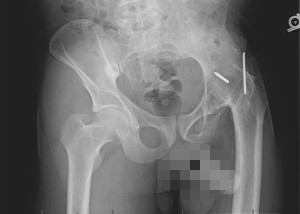XRay image of hip with previous surgery for arthrodesis ( fusion of left hip).