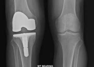 XRay showing knee implant in position after Primary Total Knee surgery for advanced osteoarthritis of the knee,