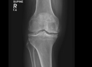 XRay showing advanced osteoarthritis of the knee before surgery.