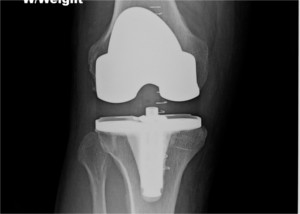 XRay image of knee, after surgery for Varus ( bow leg), with total knee replacement implant in position.