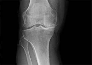 XRay image of arthritic knee of patient with severe bow leg deformity, taken before surgery.