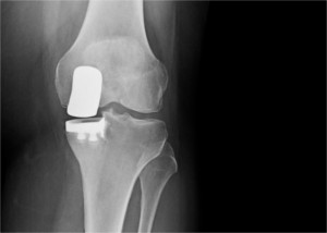 X-ray image of knee after surgery for unicompartmental arthritis of the knee, with partial knee replacement implant in