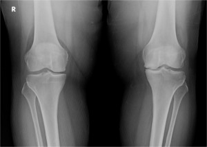 XRay image of knee before surgery, with unicompartmental arthritis.