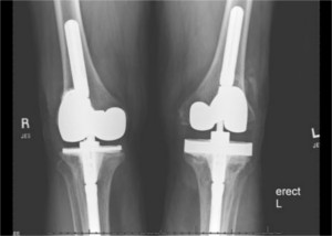 Post- op XRay image of knees showing the revision prosthesis in place.