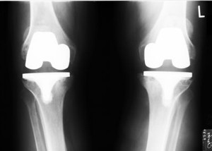 XRay image of Knees with previous knee replacements done 14 yrs. earlier showing loosening and wear of implant.