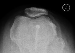 Xray image of knee joint after Surgery for Fulkerson Osteotomy (knee cap joint correction).