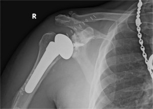 XRay image of total shoulder replacement for advanced shoulder arthritis, with shoulder implant in position after surgery.