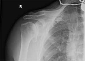 X-ray image of advanced shoulder osteoarthritis before total shoulder replacement surgery.
