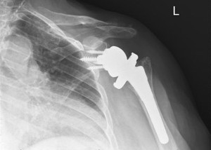 XRay image of shoulder after Reverse Total Shoulder Replacement with implant in place.