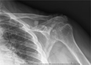 XRay image of injured shoulder joint before Reverse Shoulder Surgery.