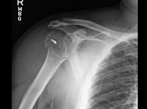 Xray image of JG's injured shoulder revealing fracture with dislocation of head of humerus.
