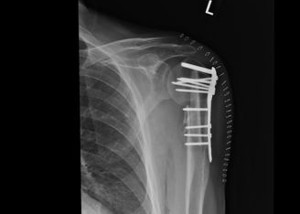 XRay image of shoulder showing plate and screws in position after surgery for a displaced and comminuted fracture of the left proximal humerus.