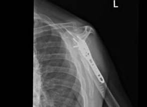 XRay image of shoulder showing a bone allograft in place after surgery for a displaced and comminuted fracture of the left proximal humerus.