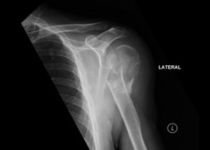 XRay image of shoulder showing a displaced and comminuted fracture of the left proximal humerus.