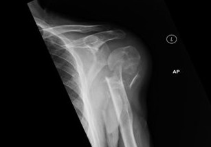 XRay image of shoulder showing a displaced and comminuted fracture of the left proximal humerus. view 2.